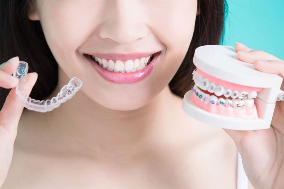 Invisalign clear aligners