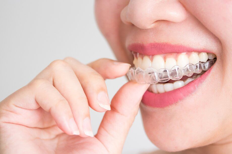 How Does Invisalign Work?