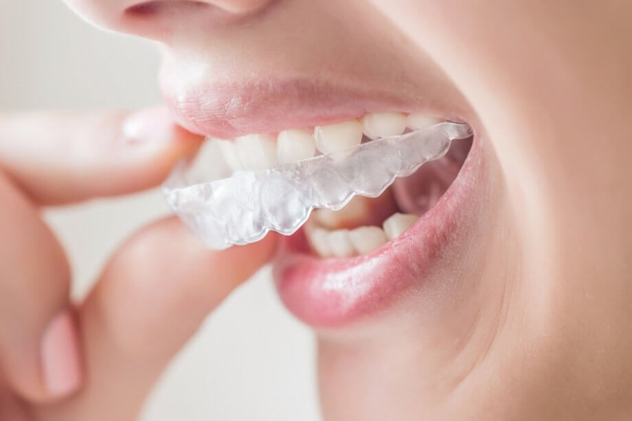 woman inserts Invisalign clear aligner tray into mouth